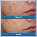 CeraVe Acne Foaming Cream Cleanser With 10% Benzoyl Peroxide 150ml